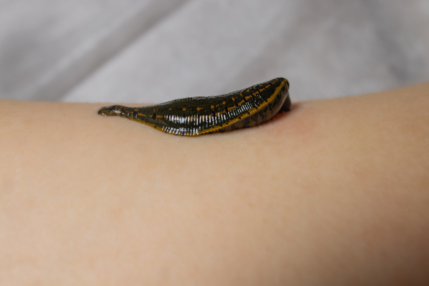 Leech Therapy